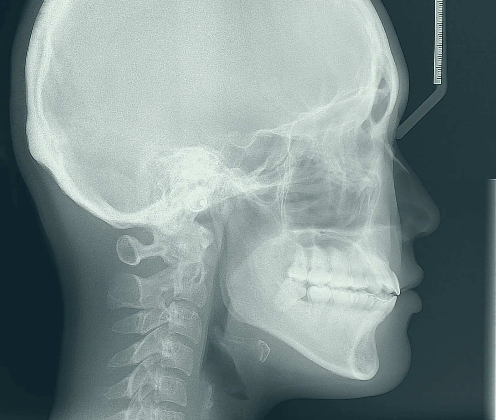 Lateral cephalometric radiograph of a human skull and jaw in profile, tinted blue-green.